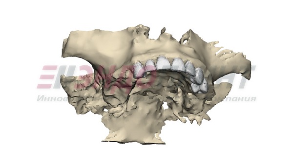 3D модель челюсти пациента, преобразованная из компьютерной томограммы